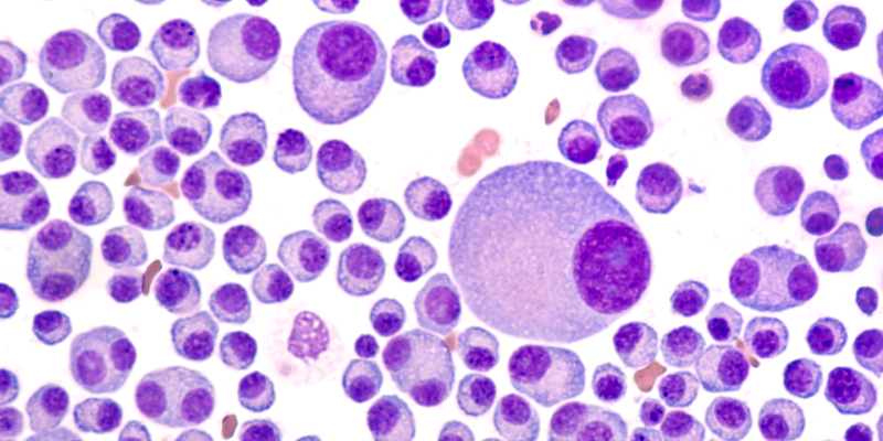 Triplet May Improve PFS in Patients with Newly Diagnosed Multiple Myeloma