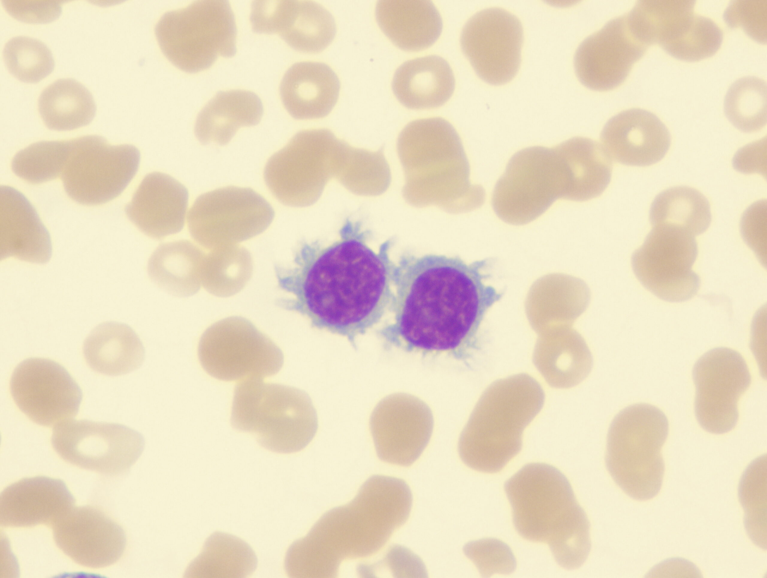 Isolating CD34-Positive Samples: MRD Analysis in MDS