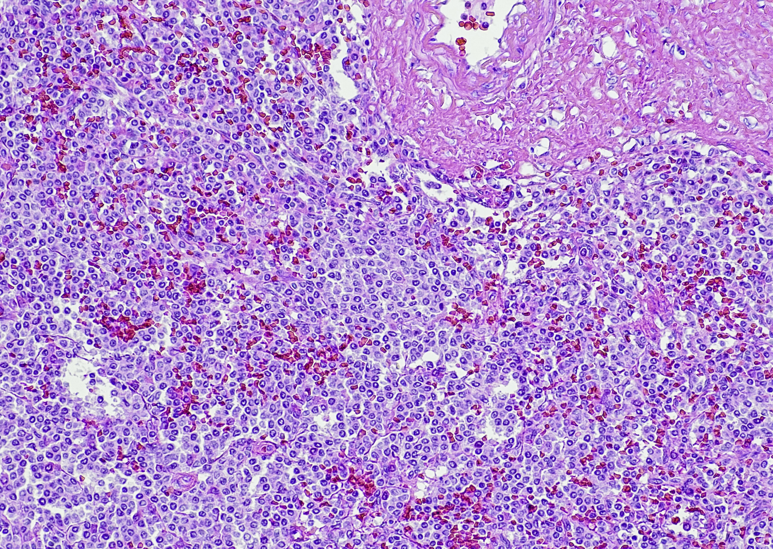 Involuting Marginal Zone Orelabrutinib Emerges With Promising Results in Advanced Marginal Zone ...