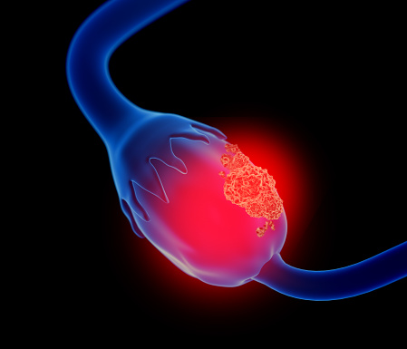 Epithelial Ovarian Cancer Incidence and Survival Changes from 1995-2014