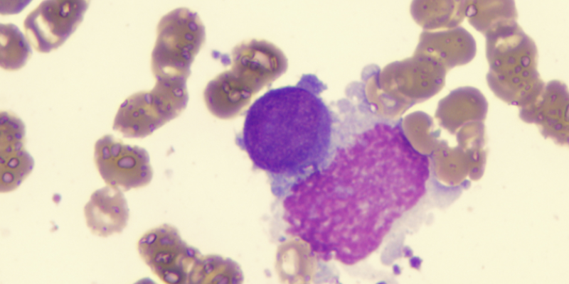 Higher Baseline Quality of Life Linked to Longer Overall Survival in Myelofibrosis