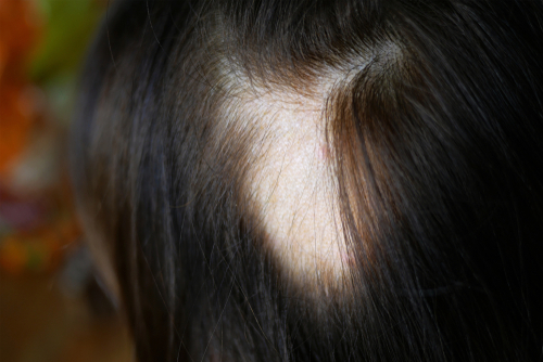 Chronic GVHD Alopecia: A Potential Early Sign of Disease
