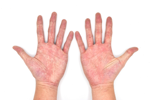 Erythema Better Predictor of Death in Chronic GVHD Than Skin Score