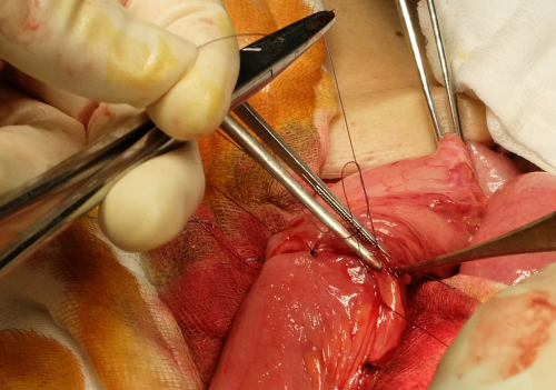 Prior Inguinal Hernia Repair and Anastomotic Leakage in Colorectal Surgery