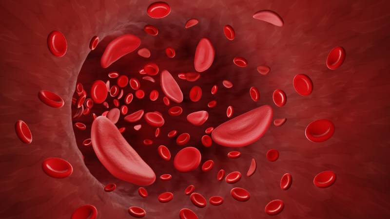 How Allogeneic HSCT Affects the Lifespan of RBCs in Patients With Sickle Cell Disease