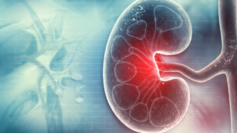 The 'R' in CRAB: Myeloma-Induced Renal Insufficiency