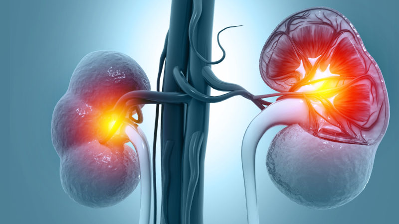 Atypical Chronic GVHD: Renal Manifestations