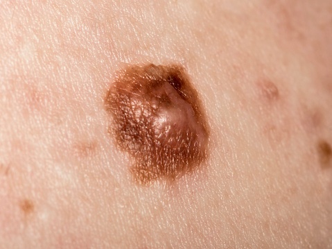 New Cancer Vaccine is 100% Effective in Mice With Aggressive Melanoma