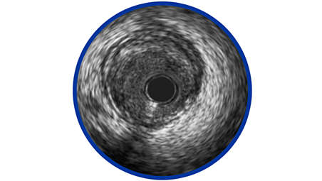 ULTIMATE: IVUS Linked with Improved Outcomes in DES Implantation