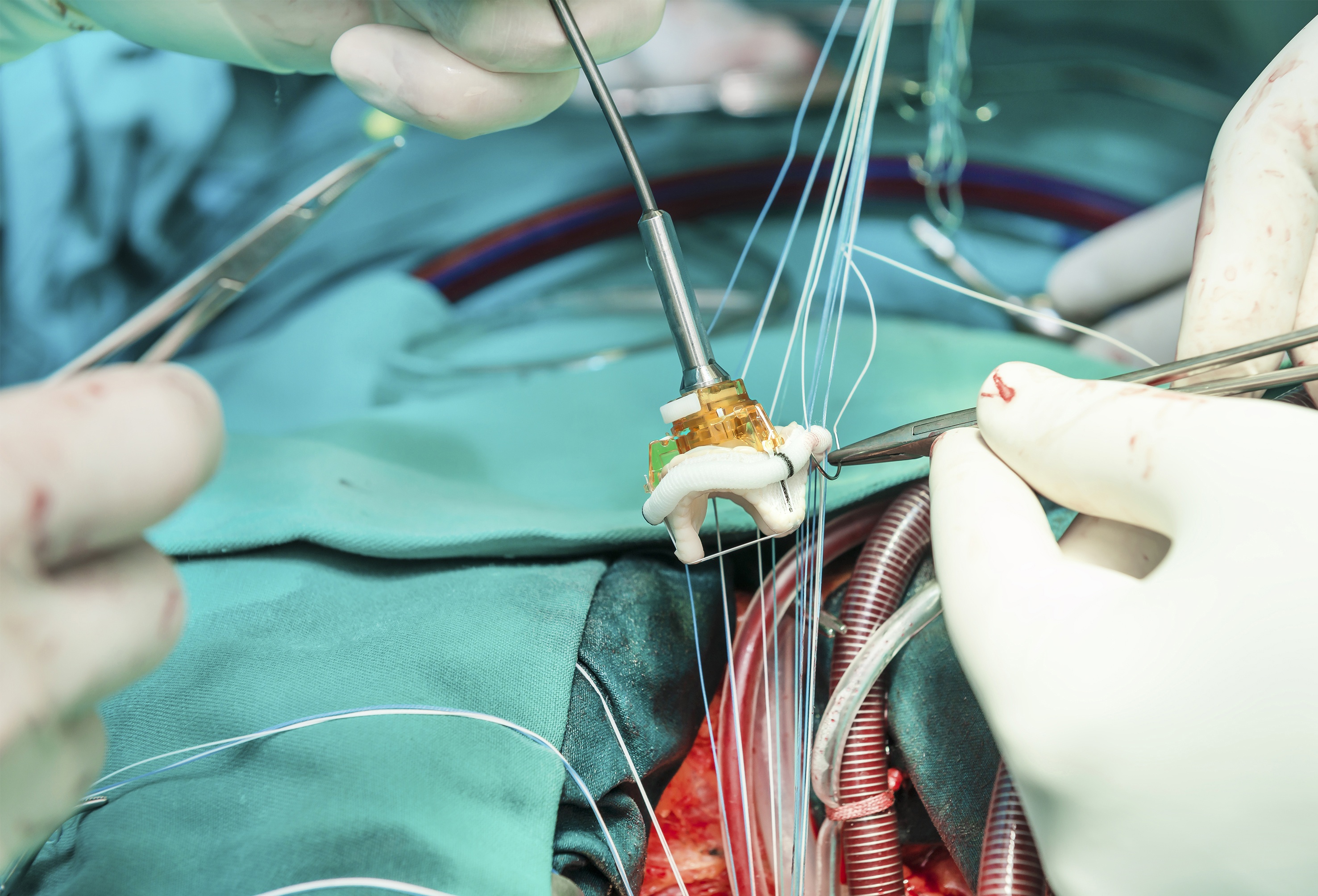 TAVR as Good as Surgery for Low-surgical-risk Patients