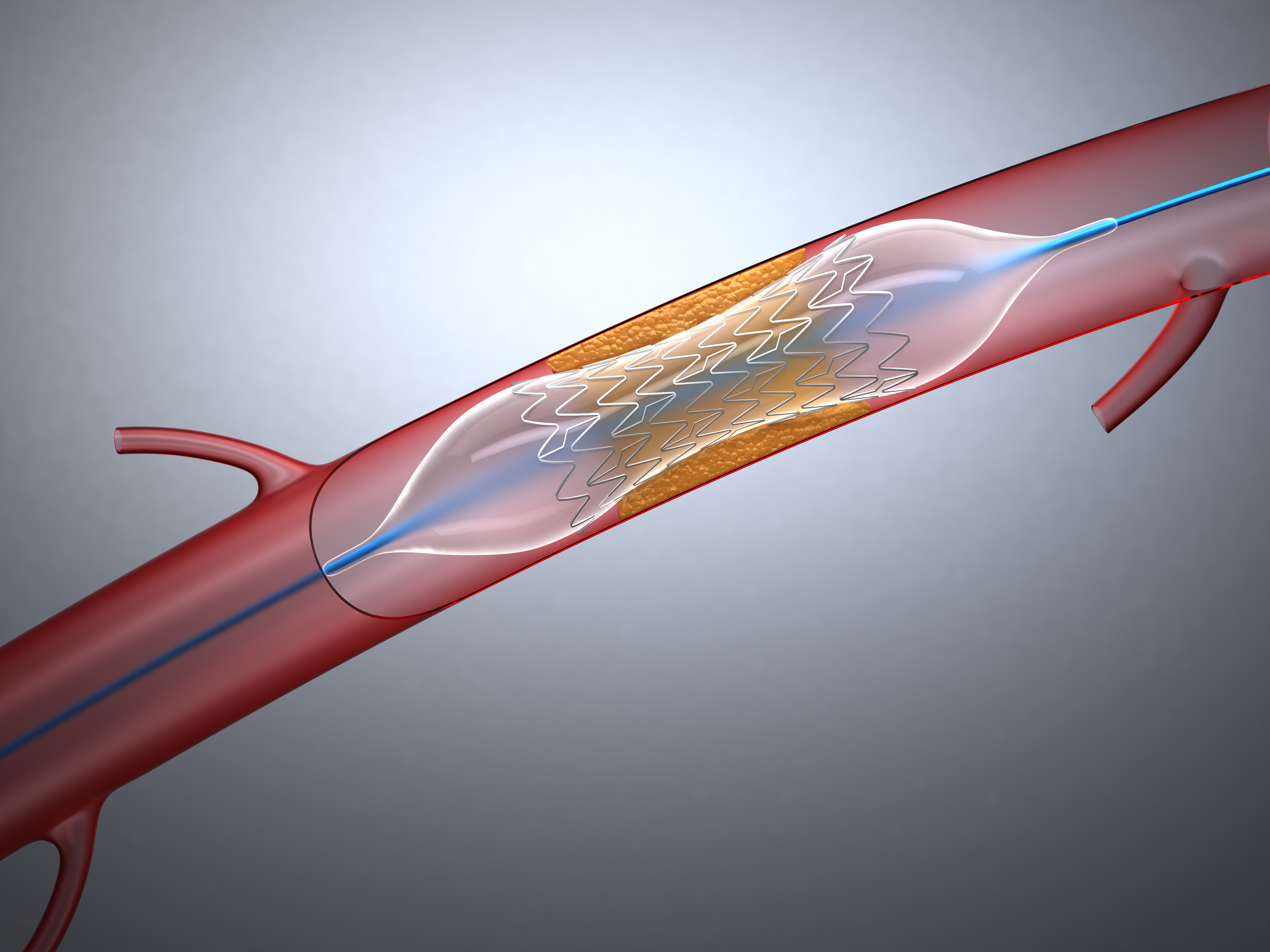 Intra-Aortic Balloon Pump for High-Risk Percutaneous Coronary Intervention