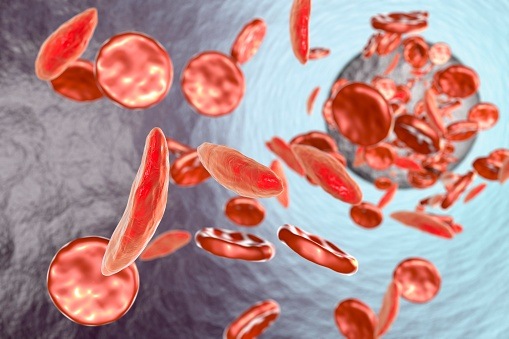 EHA: Voxelotor for Sickle Cell Disease Has Disease-Modifying Potential