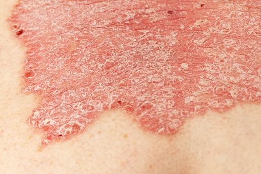 Patient Characteristics at Diagnosis May Predict 10-Year Psoriasis Disease Course