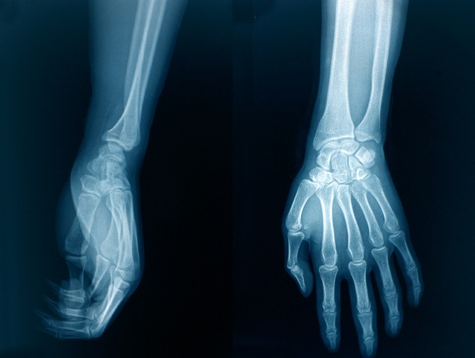 Perfect Anatomic Alignment in Distal Radius Fractures Does Not Mean ...