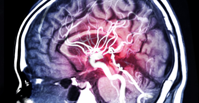 Most Patients with Intracerebral Hemorrhage Experience at Least Mild Sleep Disordered Breathing
