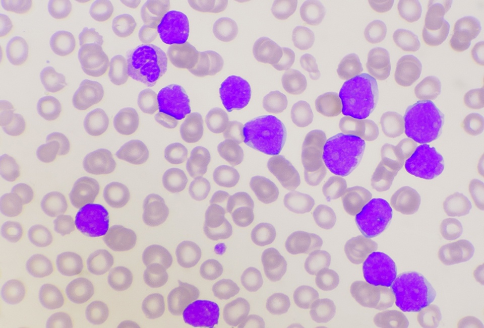 Promising Results With Magrolimab Added to Azacitidine With Venetoclax in Newly Diagnosed, High-Risk Acute Myeloid Leukemia