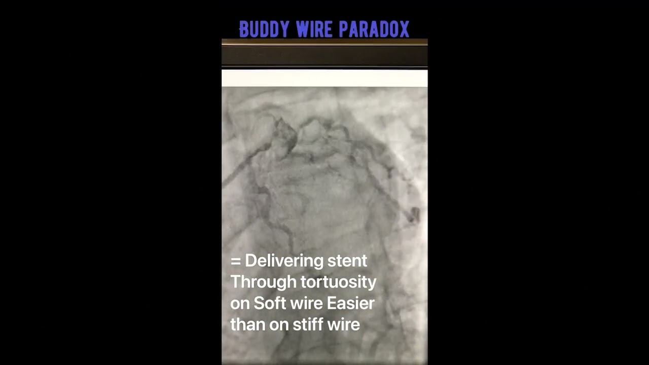 Practice Tips with Dr. Lichaa: The Buddy Wire Paradox