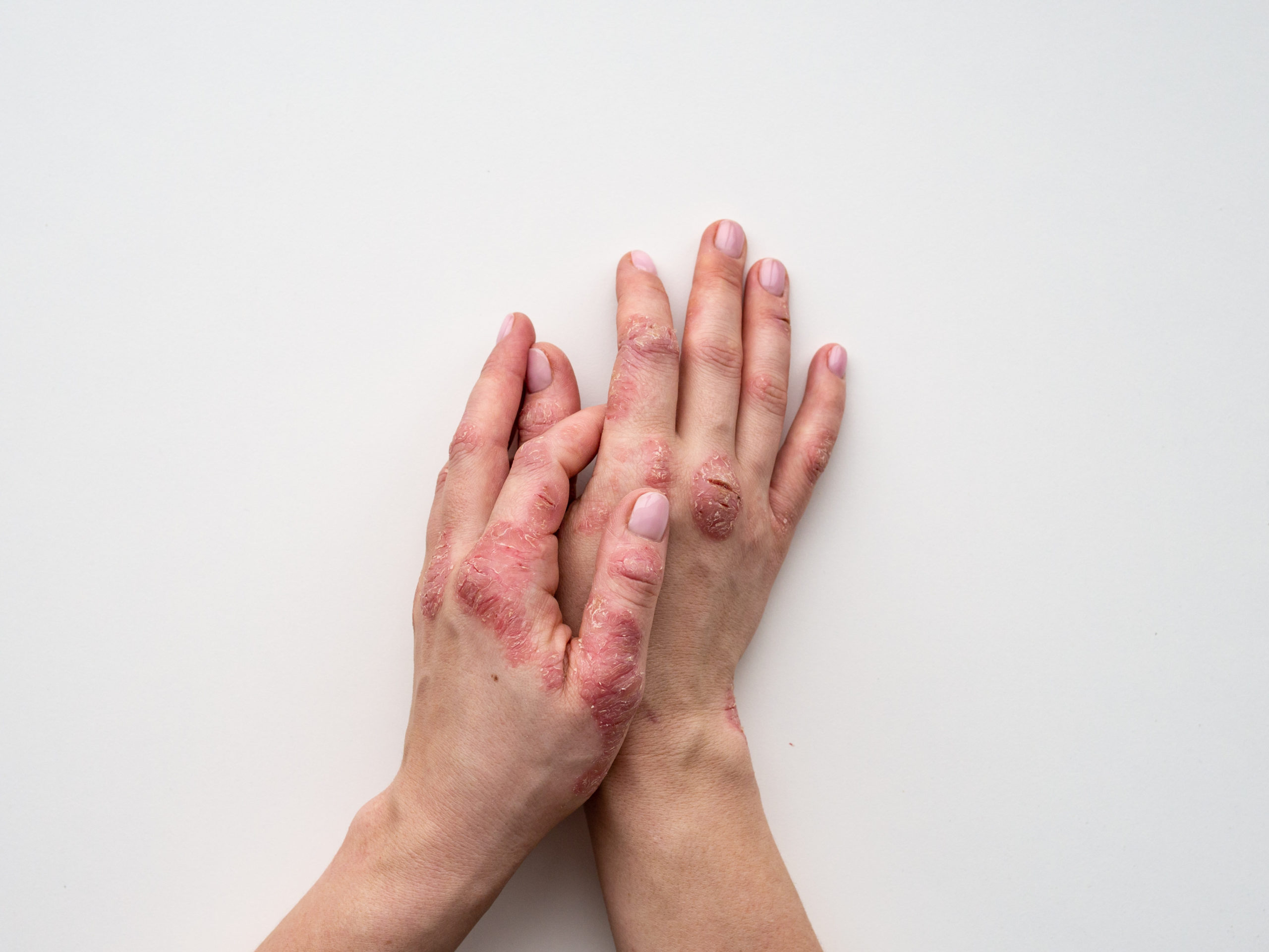 Psoriasis and Risk of Adverse Cardiovascular Outcomes
