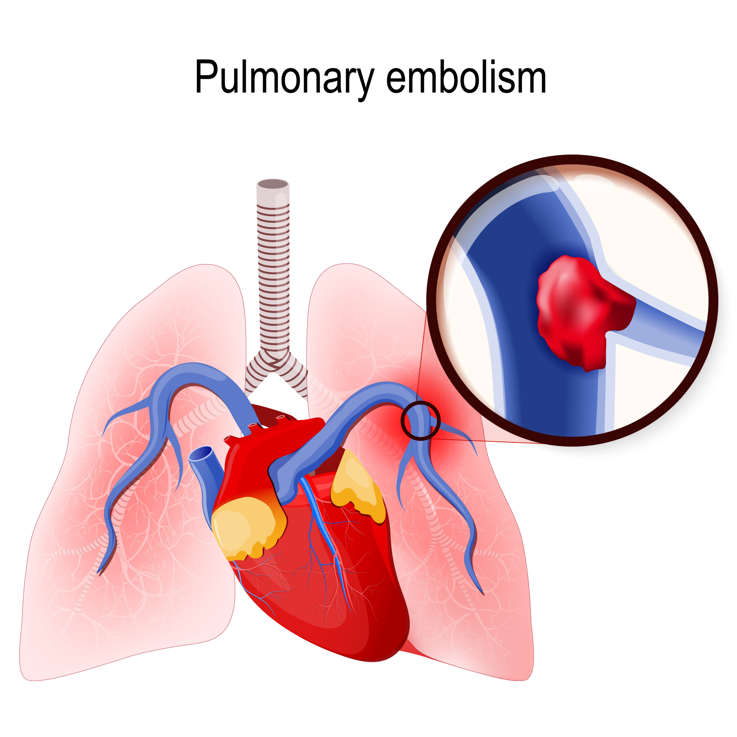 Atrial Fibrillation in Acute Pulmonary Embolism: Prevalence and Prognosis