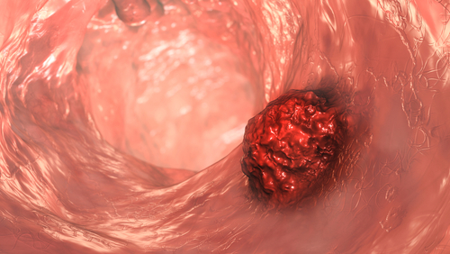 Prognostic Value of Malignant Features, Lateral Lymph Node Size in Rectal Cancer