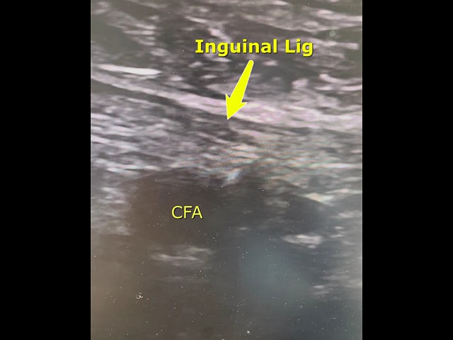 Practice Tips with Dr. Lichaa: The Importance of Identifying the Inguinal Ligament by Ultrasound