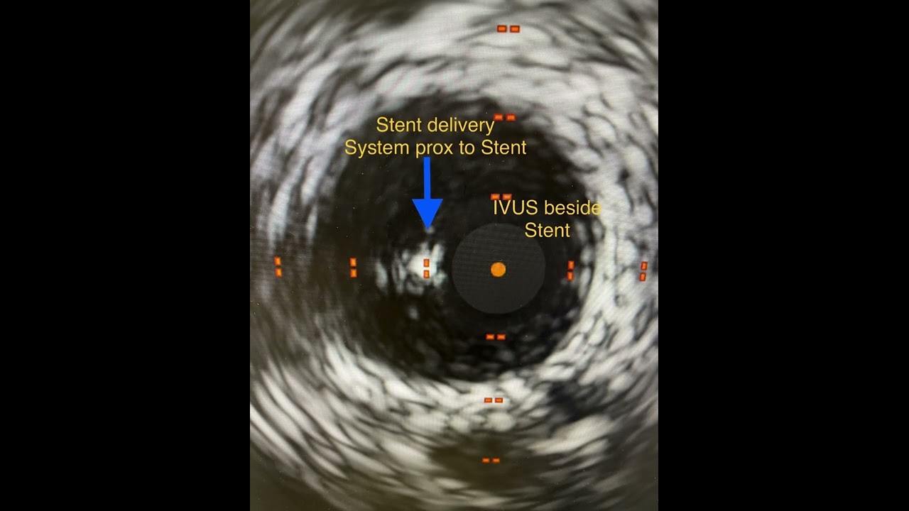 Practice Tips with Dr. Lichaa: The Live IVUS Stenting Technique