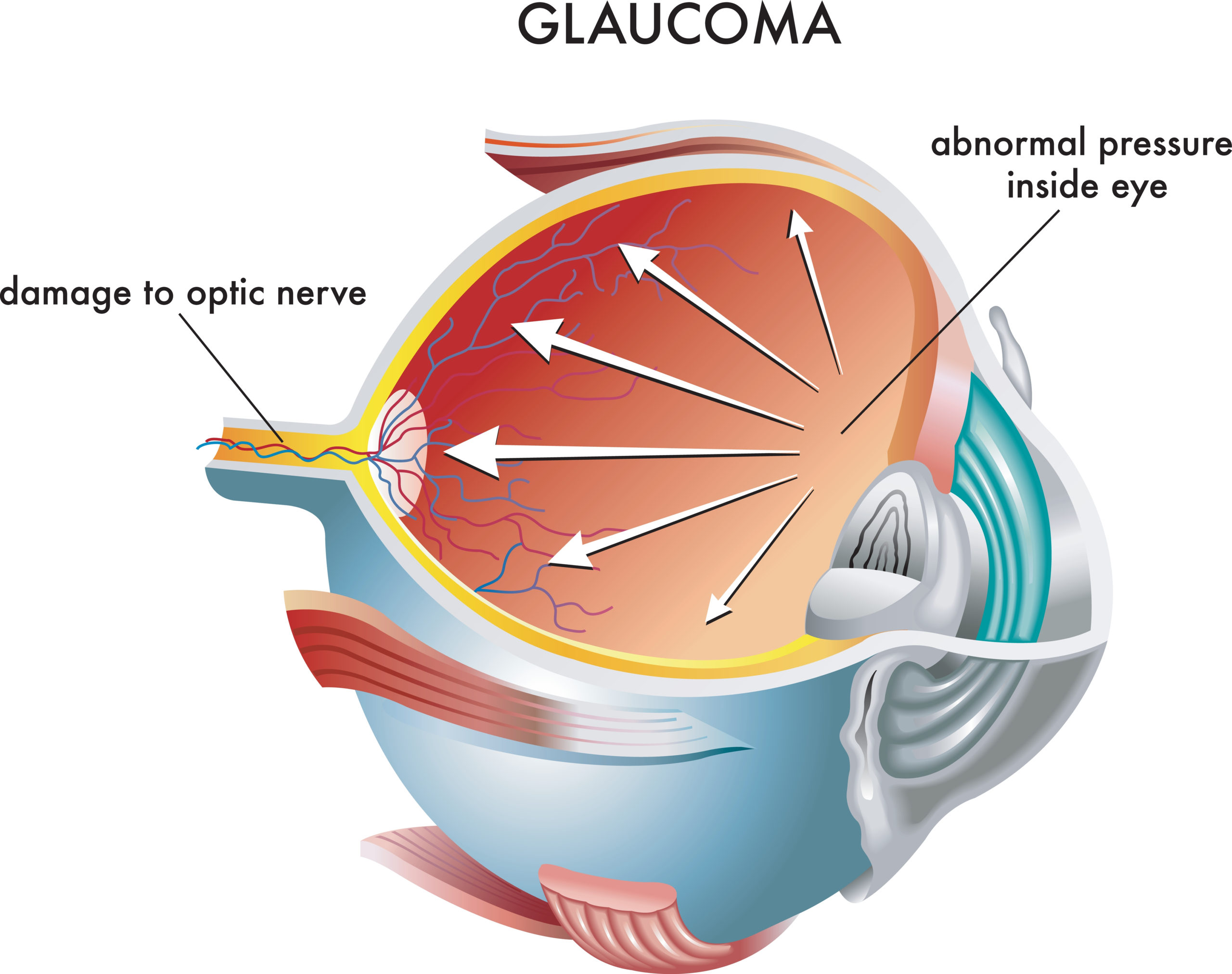 Intraocular Pressure And Retinal Nerve Fiber Layer Thinning In Glaucoma