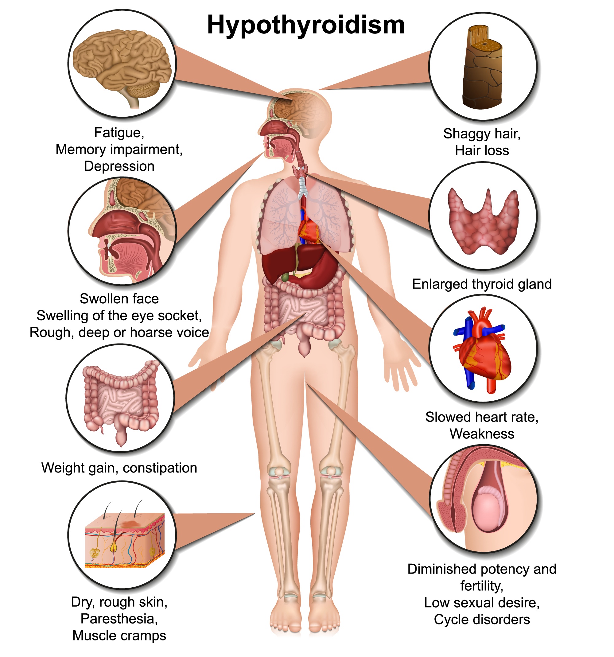 Rheumatoid Arthritis Associated With Thyroid Dysfunction Docwire News