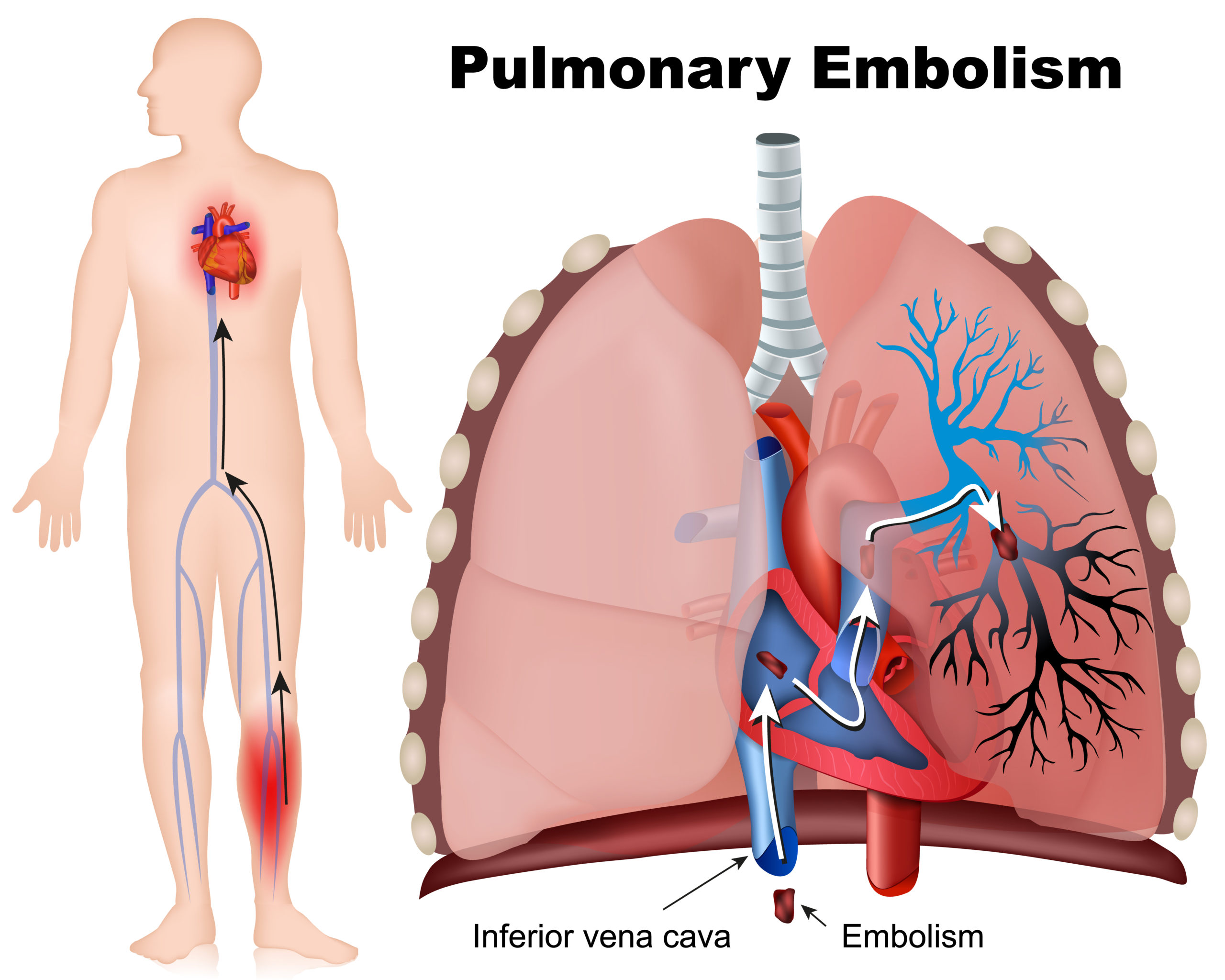 Predictive Model for Pulmonary Embolism Risk in Lung Cancer