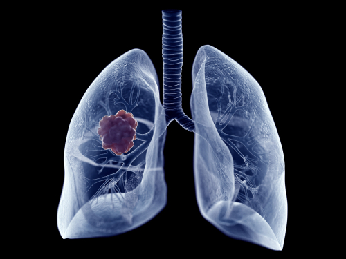 Exploring the Necessary Diagnostic Workup in Non-Small Cell Lung Cancer