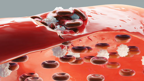 The Right Approach for Evaluating a Patient With Suspected Hemophilia