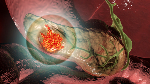 Pancreatic Enzyme Replacement Therapy for Patients With Advanced Pancreatic Adenocarcinoma