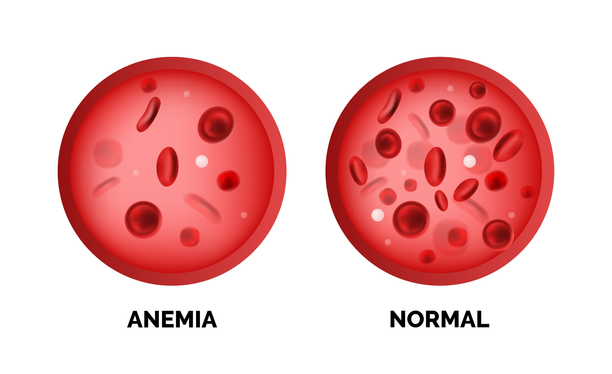 Anemia, Inflammation Linked to Dementia Plus Cognitive Decline