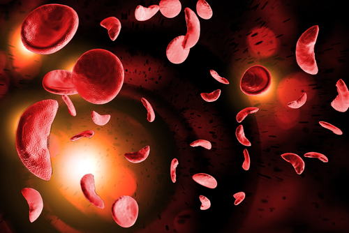 Stem Cell Gene Therapy Shows Promise as Treatment for Sickle Cell Disease