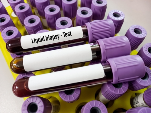 The Role of Liquid Biopsy in Predicting Survival Outcomes