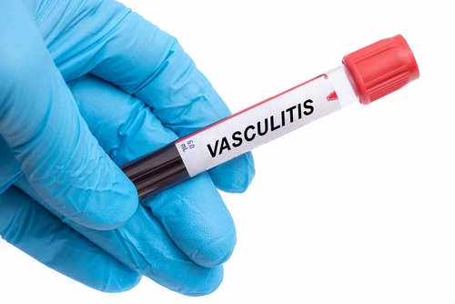 ANCA-Associated Vasculitis as a Large-Vessel Vasculitis?