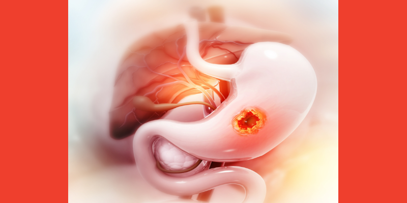 Neoadjuvant IO, Chemo Demonstrates Promising Antitumor Activity in Early Gastric, Gastroesophageal Cancer