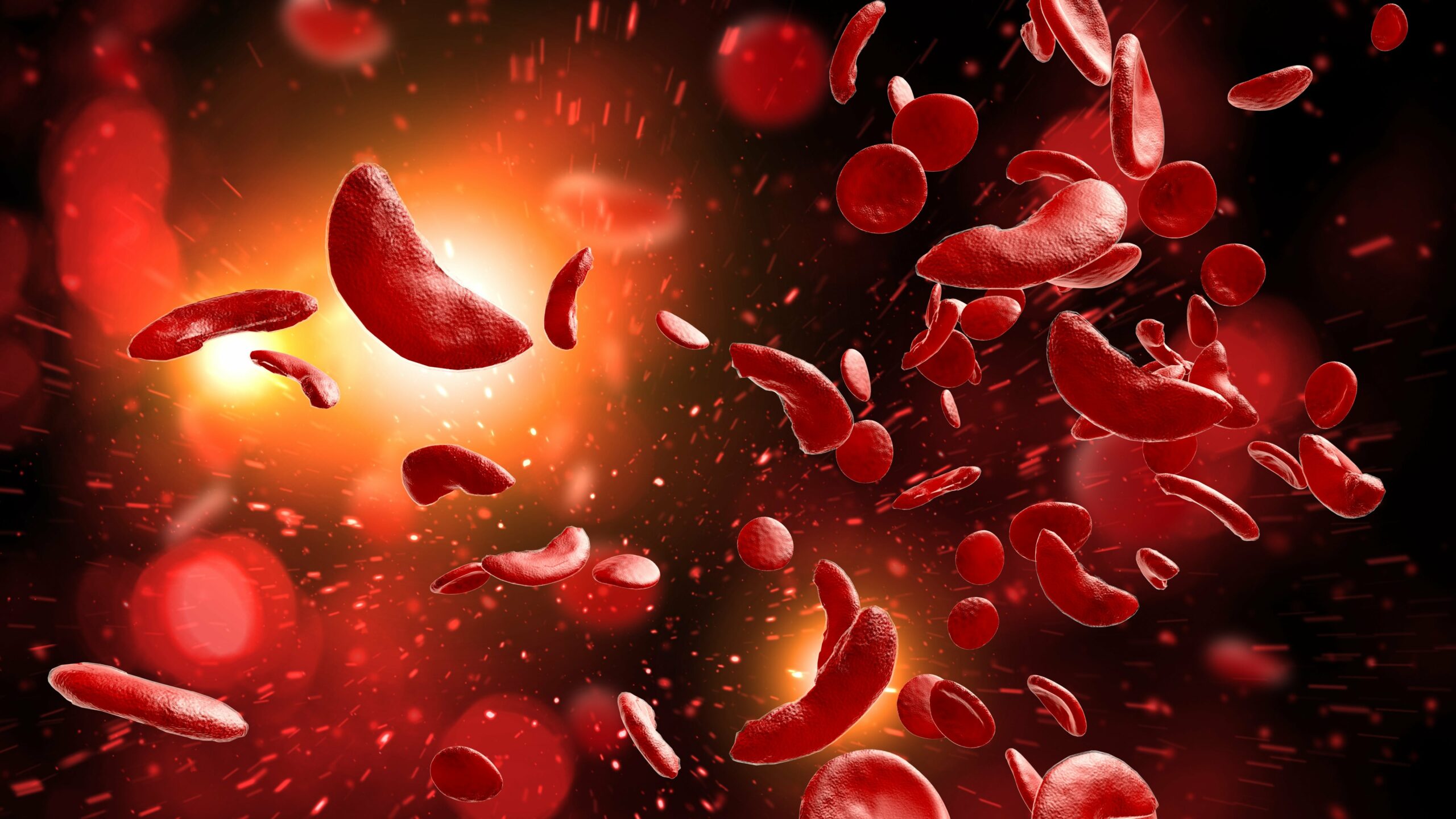 HO-1 Levels Elevated in Children Versus Adults with Sickle Cell Disease