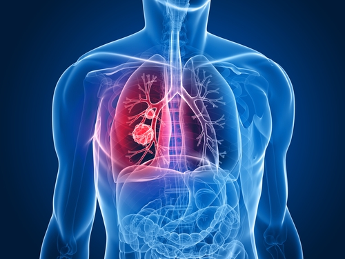 Researchers Report Primary Results of TROPION-Lung05