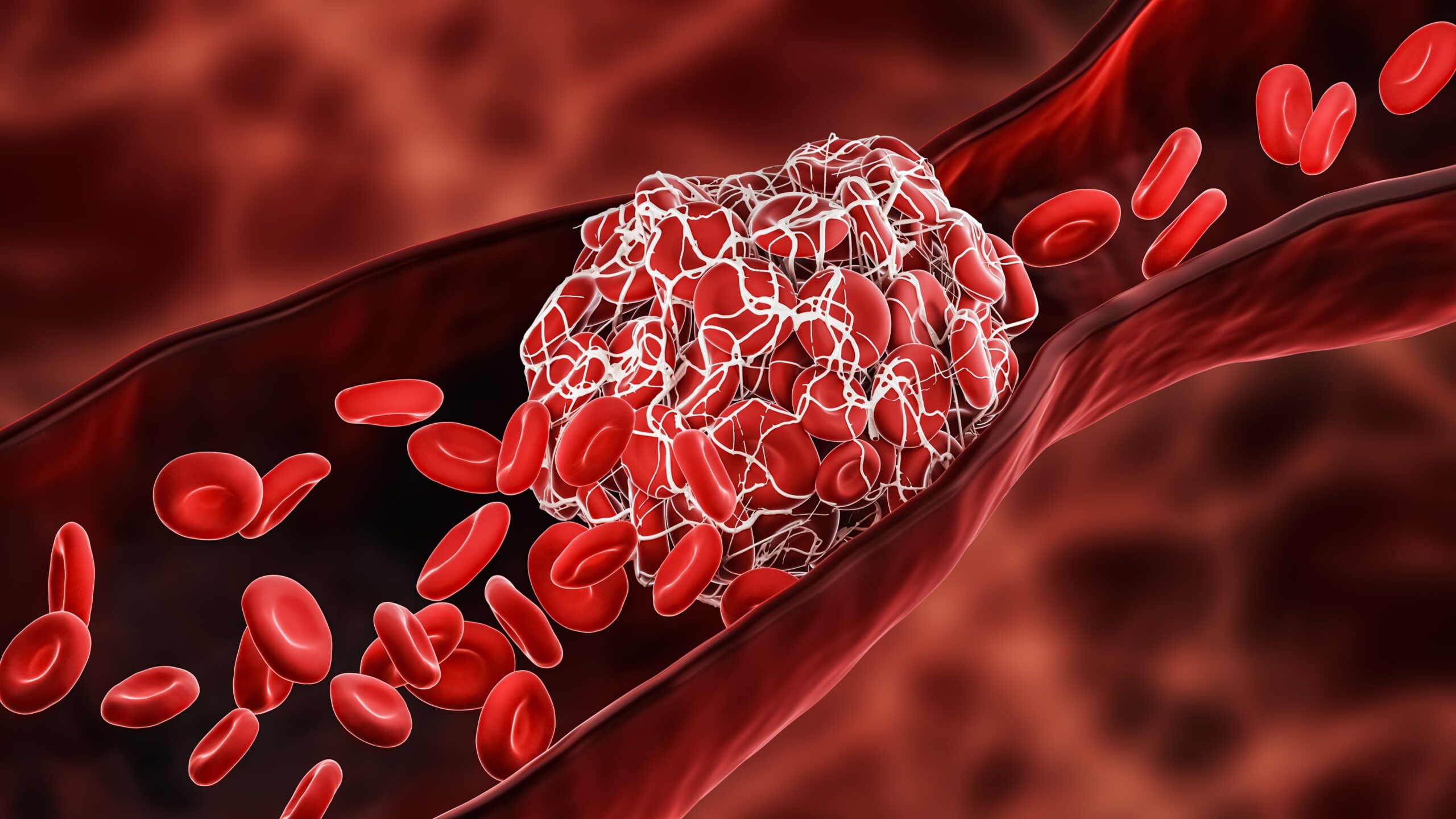 Nationwide Database Study Describes Intracardiac Thrombosis in Patients with COVID-19
