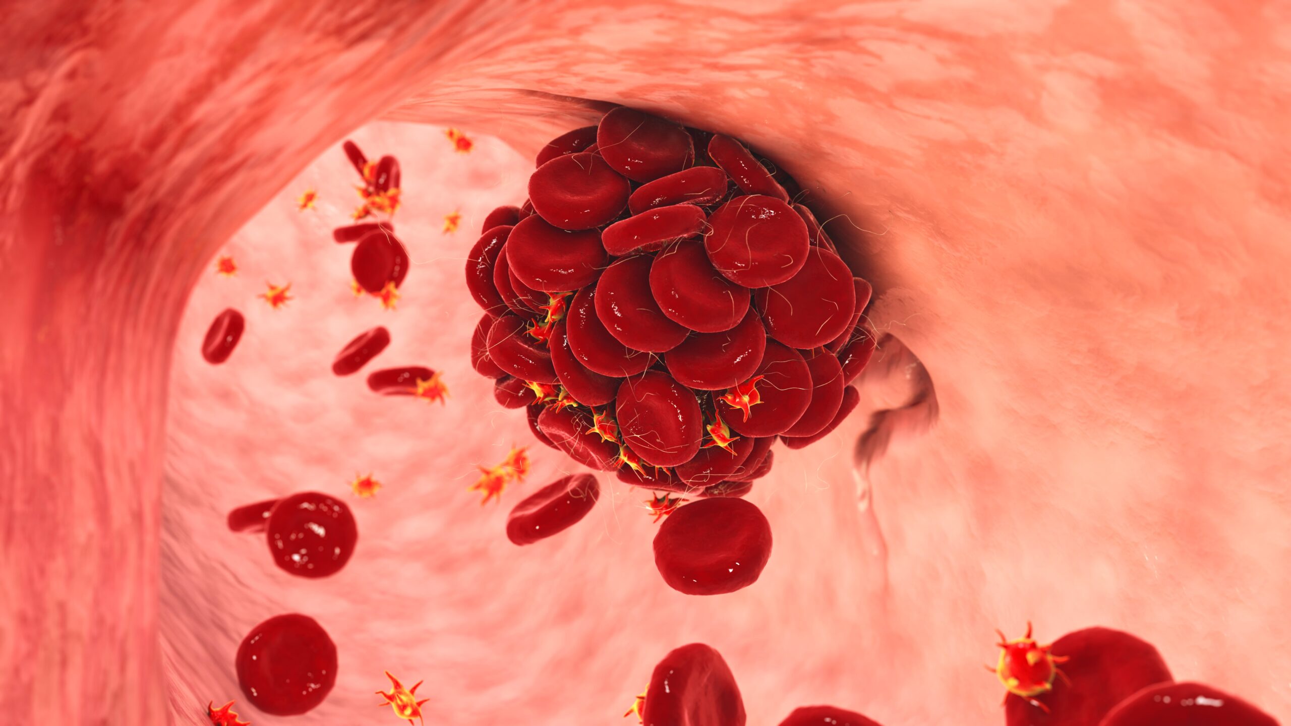 VRd Associated with Lower Thromboembolic Risk Versus KRd in Myeloma