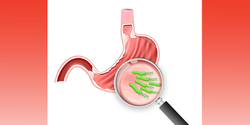 Anti–H Pylori Treatment May Improve Survival in Patients With Gastric Cancer