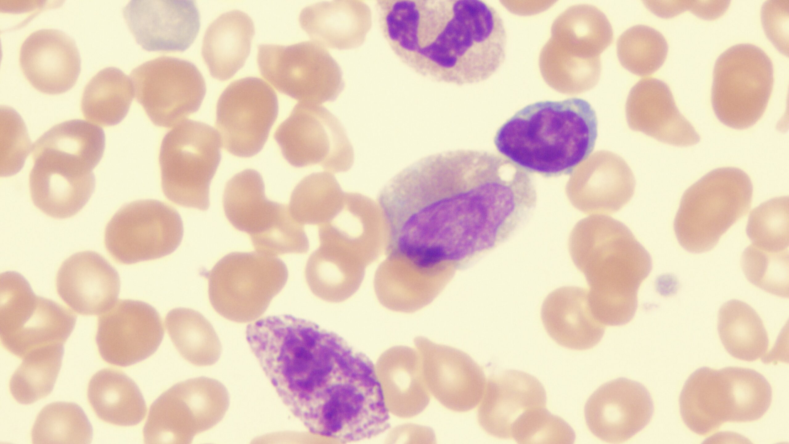 Study Finds Bone Marrow Changes Not Linked With Myelofibrosis Treatment Benefits