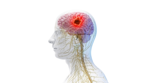 Advancements in Primary Brain Cancers With Dr. Manmeet Ahluwalia