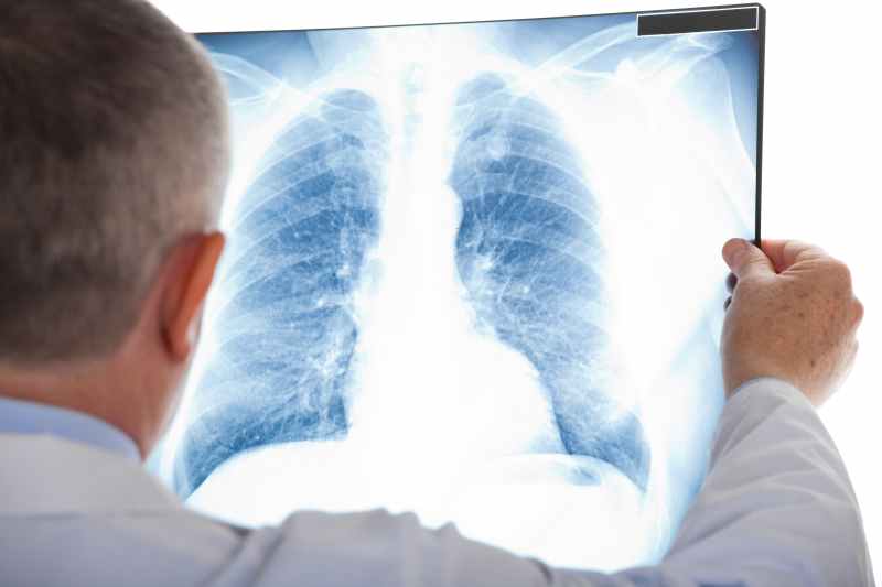 Cemiplimab Regimen Shows Survival Benefit Versus Chemotherapy Alone in Advanced NSCLC