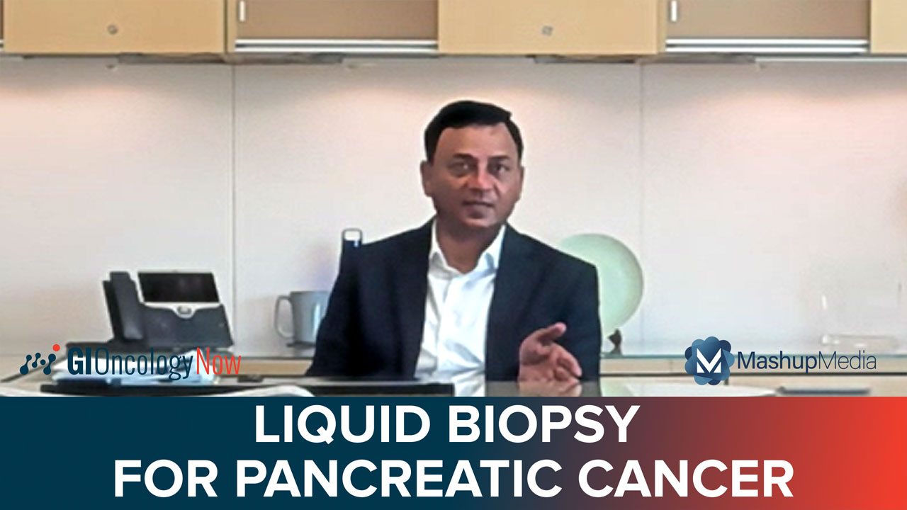 Liquid Biopsy With Biomarker CA 19-9 Accurately Detects Early-Stage Pancreatic Cancer