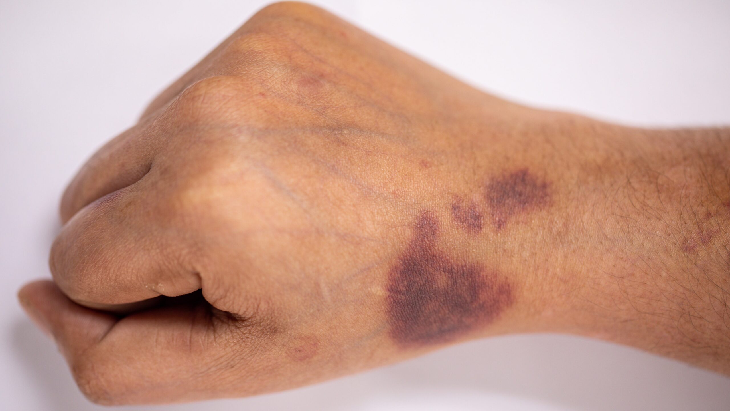 Study Examines Factors Linked With Bleeding Risk in Severe Hemophilia