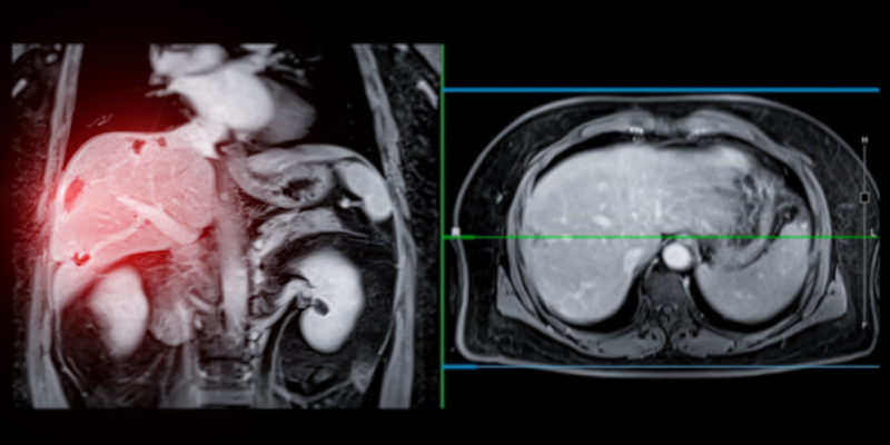 SBRT Plus Sorafenib Boosts OS Over Sorafenib Alone for HCC