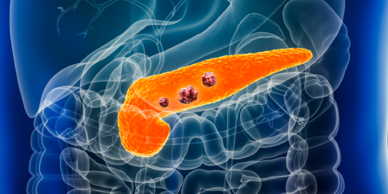 Tumor Treating Fields With Gemcitabine, Nab-Paclitaxel Improve OS in Advanced Pancreatic Cancer