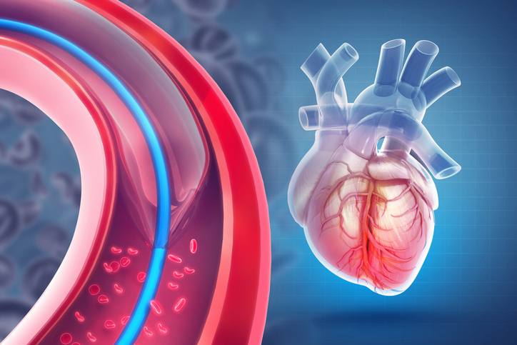 DCB-BIF Trial Results Favor Use of Drug-Coated Balloons to Rescue Jeopardized Side-branches After Provisional Bifurcation Stenting